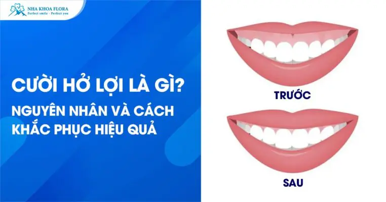 Nguyên Nhân Và Cách Khắc Phục Hiệu Quả Cười Hở Lợi 5