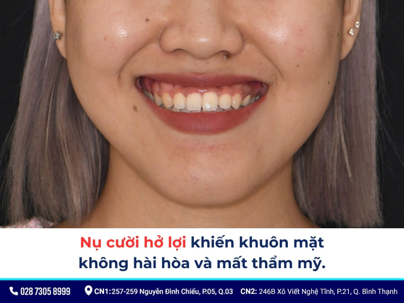 cười hở lợi thì sao