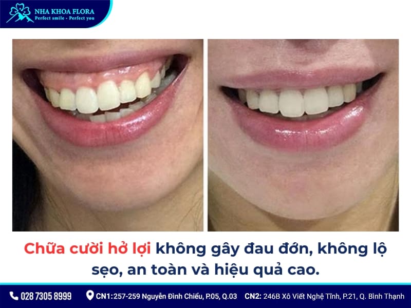 cười hở lợi thì sao