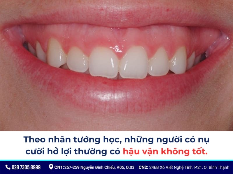 cười hở lợi thì sao