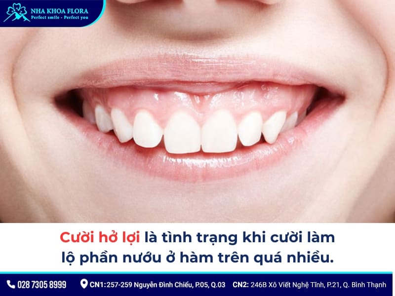 cười hở lợi thì sao