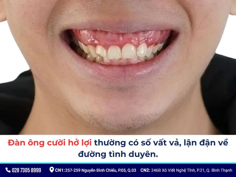 cười hở lợi thì sao
