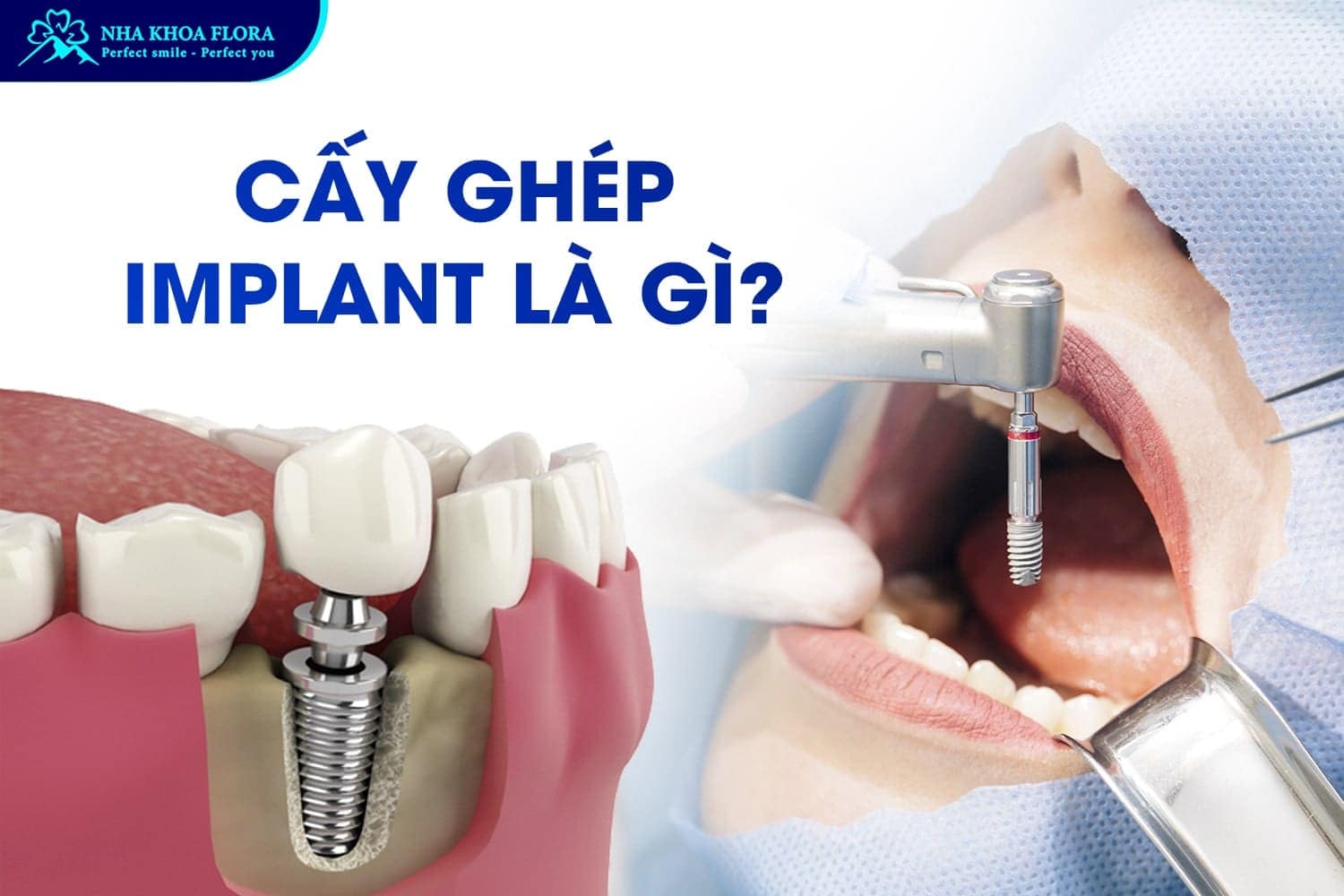 Giải Đáp Khi Nào Nên Trồng Răng Implant? - ảnh 1