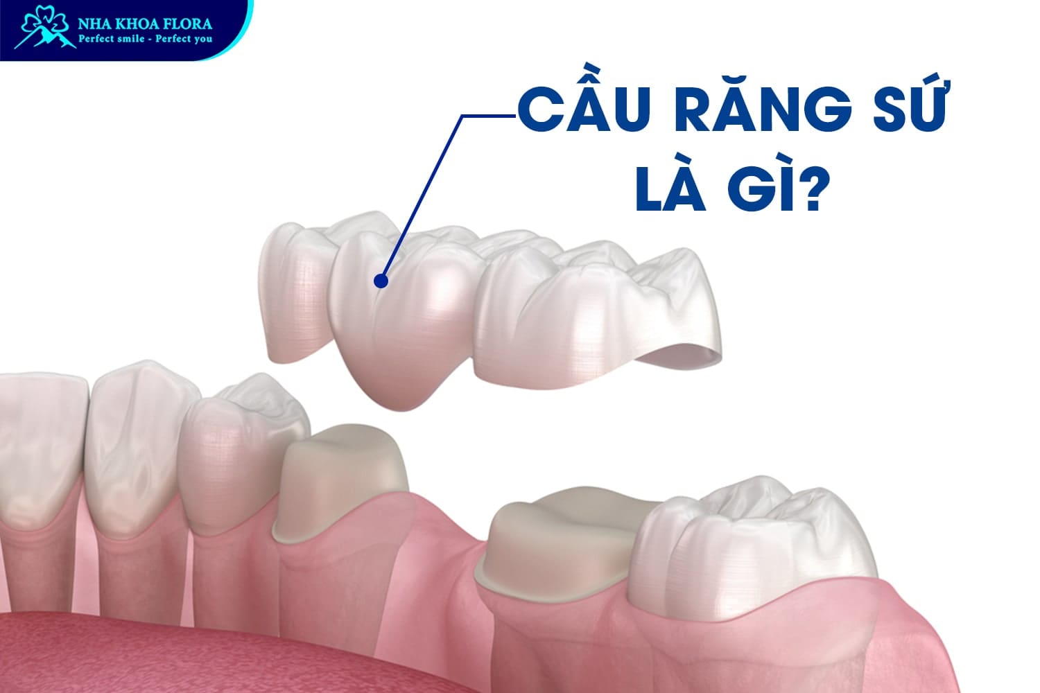 Nên Trồng Răng Sứ Hay Implant? Lựa Chọn Nào Tốt Nhất? - ảnh 1 Nên Trồng Răng Sứ Hay Implant? Lựa Chọn Nào Tốt Nhất? - ảnh 1
