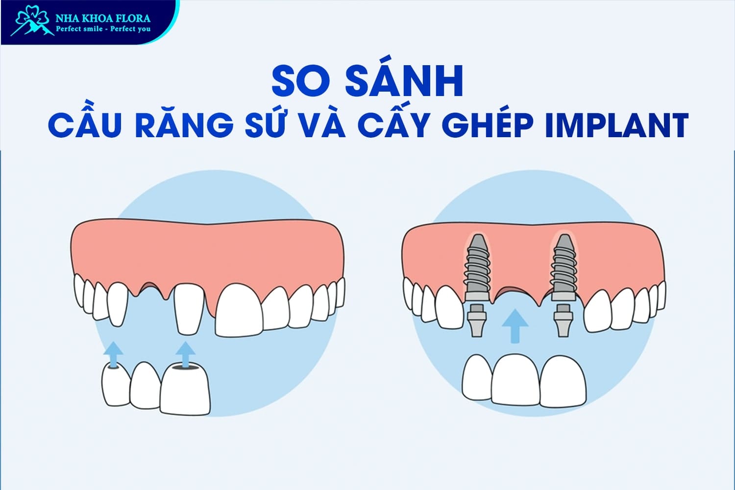 Nên Trồng Răng Sứ Hay Implant? Lựa Chọn Nào Tốt Nhất? - ảnh 3 Nên Trồng Răng Sứ Hay Implant? Lựa Chọn Nào Tốt Nhất? - ảnh 3