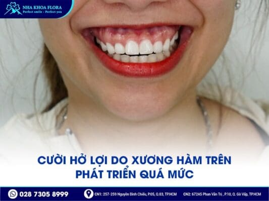 Nguyên Nhân Và Cách Khắc Phục Hiệu Quả Cười Hở Lợi 1