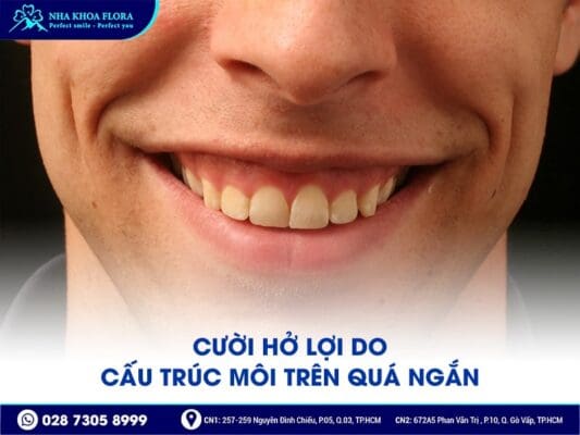 Nguyên Nhân Và Cách Khắc Phục Hiệu Quả Cười Hở Lợi 3