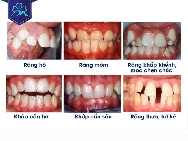 DỊCH VỤ NIỀNG RĂNG MẮC CÀI TẠI NHA KHOA FLORA 1