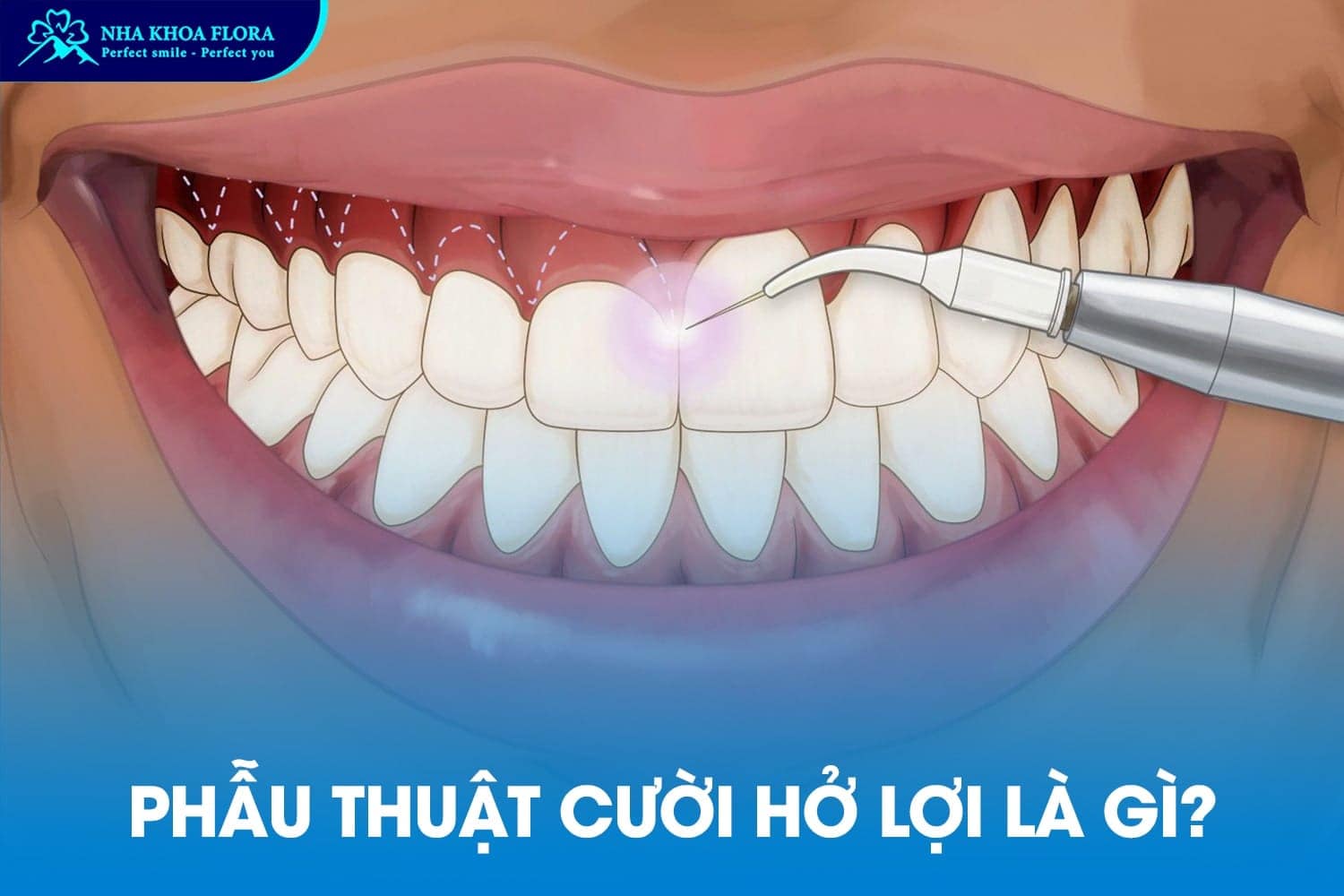Phẫu Thuật Cười Hở Lợi Có Đau Không? Giá Bao Nhiêu? - ảnh 1