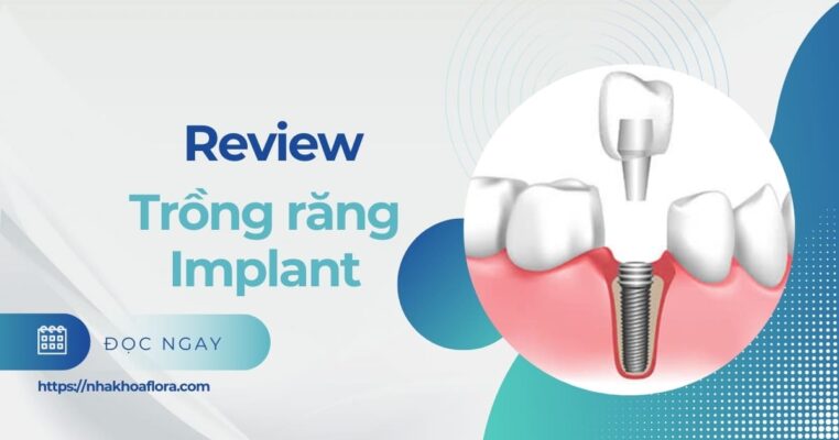 review trồng răng implant