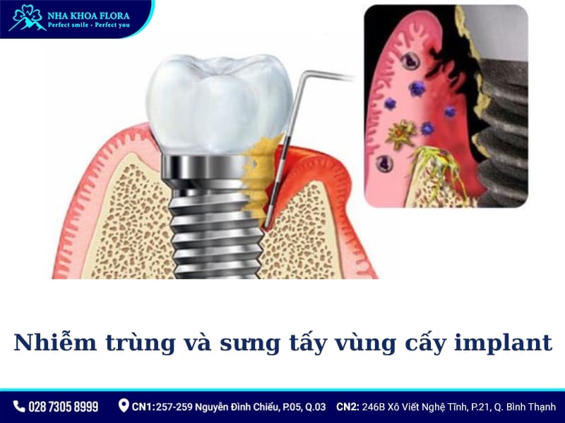 Nhiễm trùng và sưng tấy vùng cấy implant