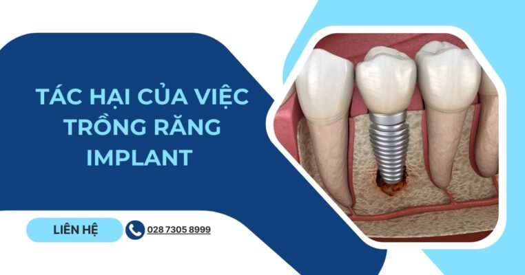 tác hại của việc trồng răng implant