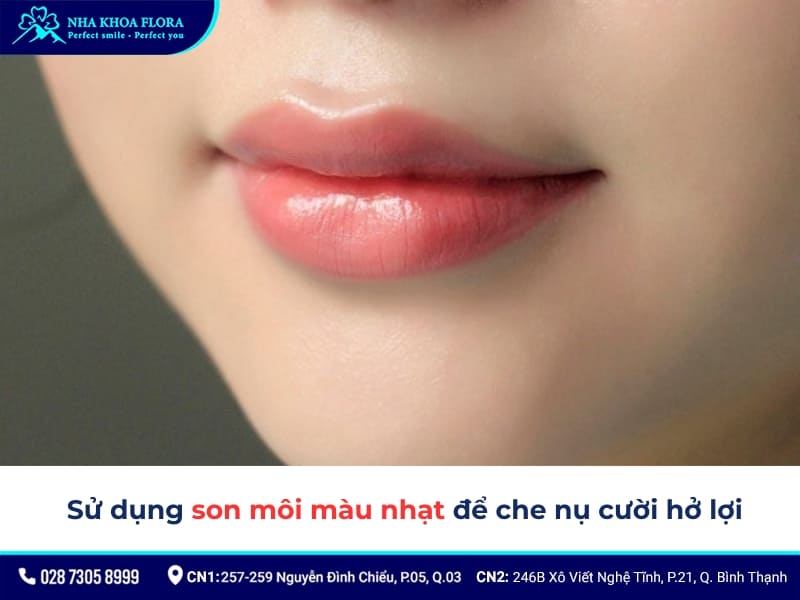 trị cười hở lợi tại nhà