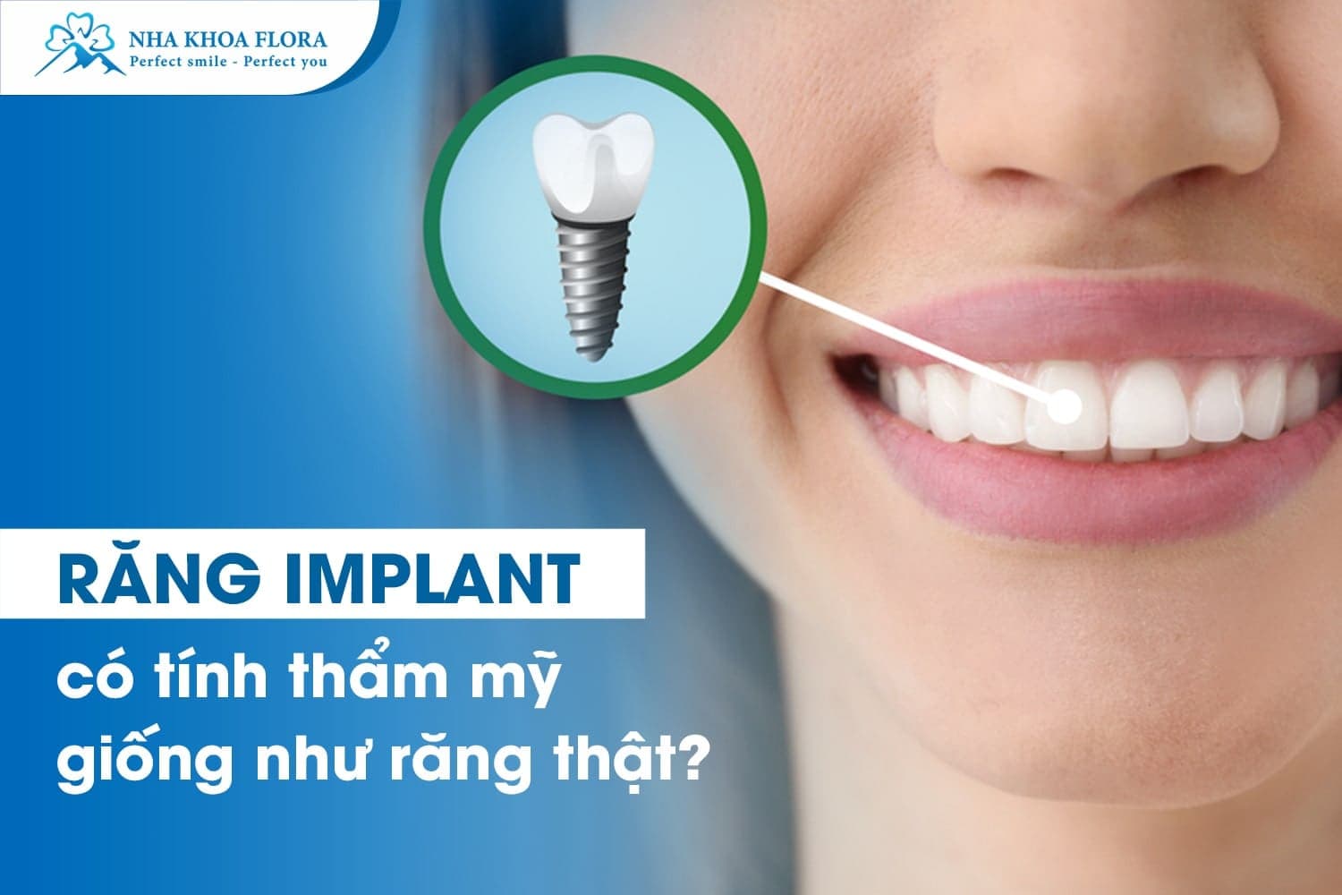 Trồng Răng Implant Bao Lâu Thì Ăn Được? - ảnh 1 Trồng Răng Implant Bao Lâu Thì Ăn Được? - ảnh 1