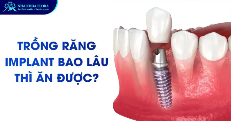 [Hỏi Đáp]: Trồng Răng Implant Bao Lâu Thì Ăn Được? 5