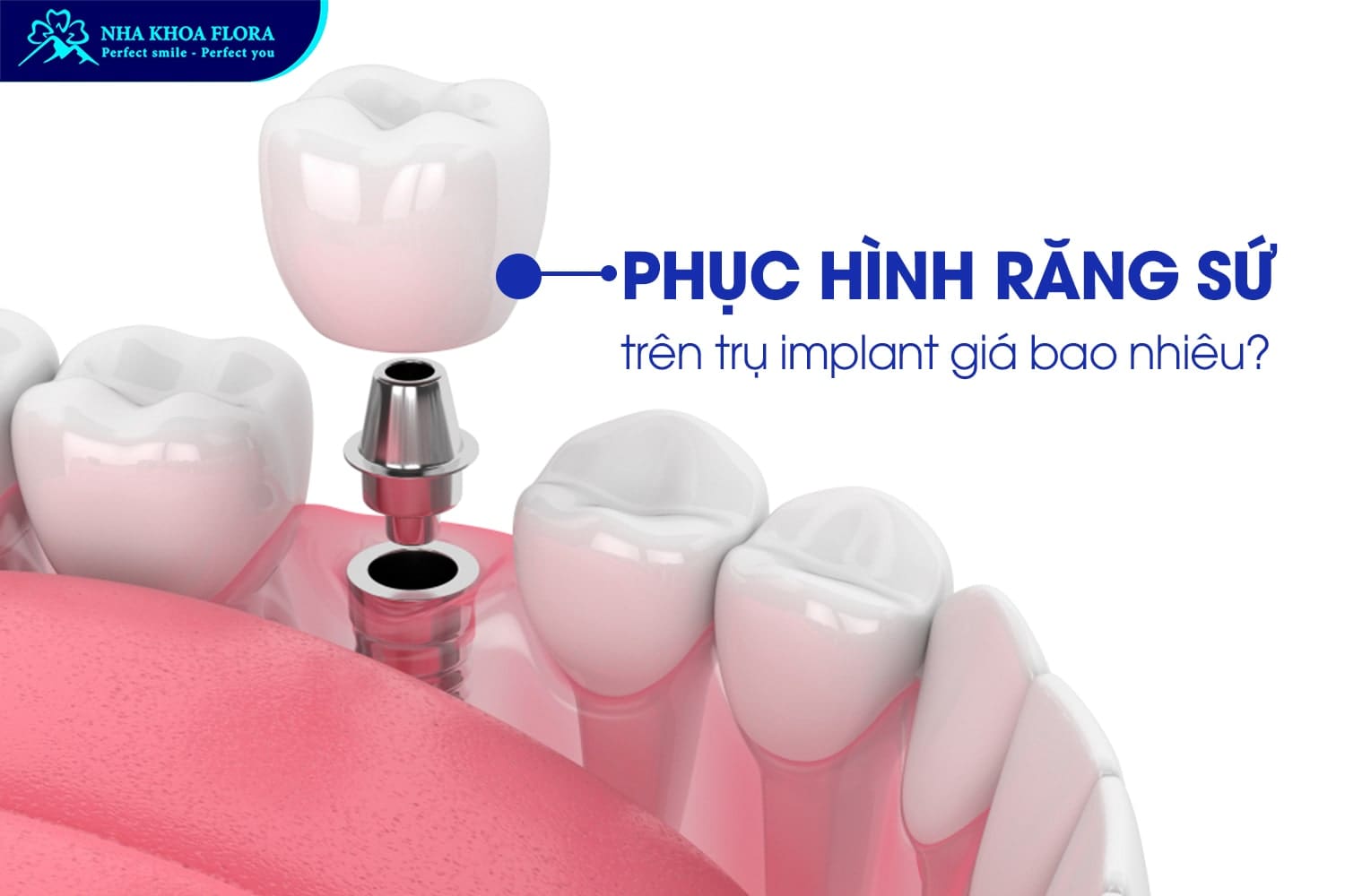 Trồng Răng Implant Giá Bao Nhiêu? - ảnh 4