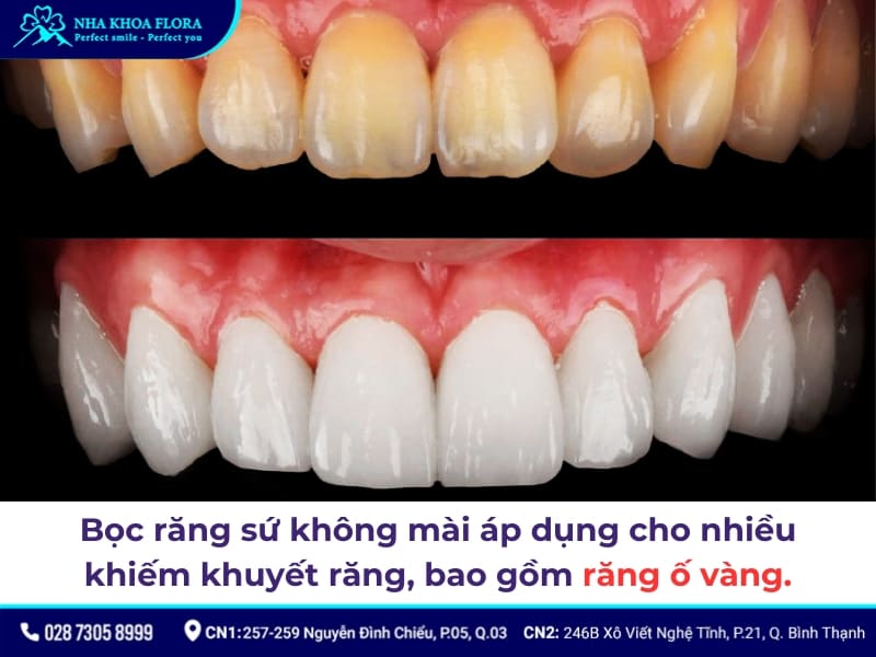 bọc răng sứ không mài