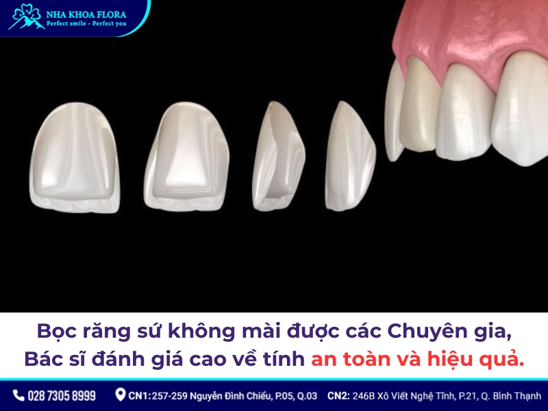 bọc răng sứ không mài