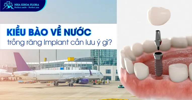 Kiều Bào về nước trồng răng Implant cần lưu ý gì? 5