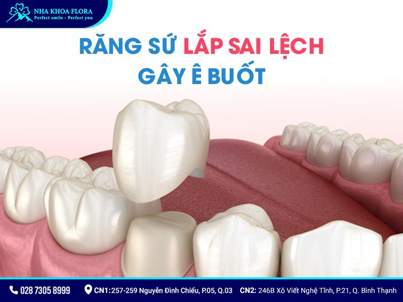 làm răng sứ sau bao lâu thì hết ê buốt