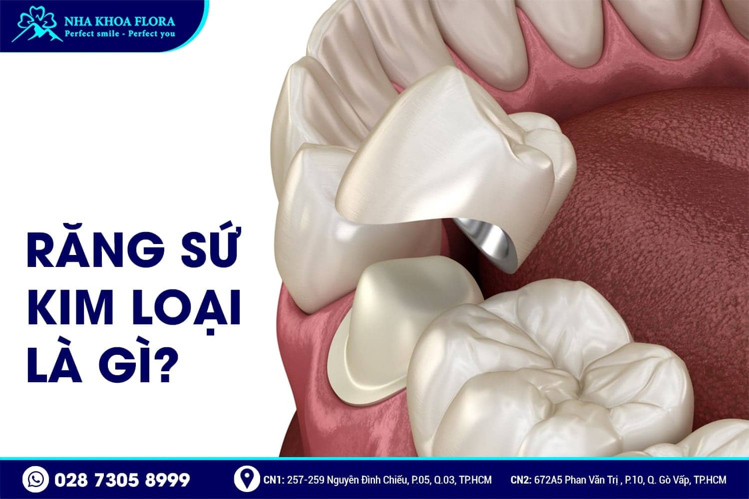 Răng Sứ Kim Loại Là Gì? Có Mấy Loại? Giá Bao Nhiêu? - ảnh 1