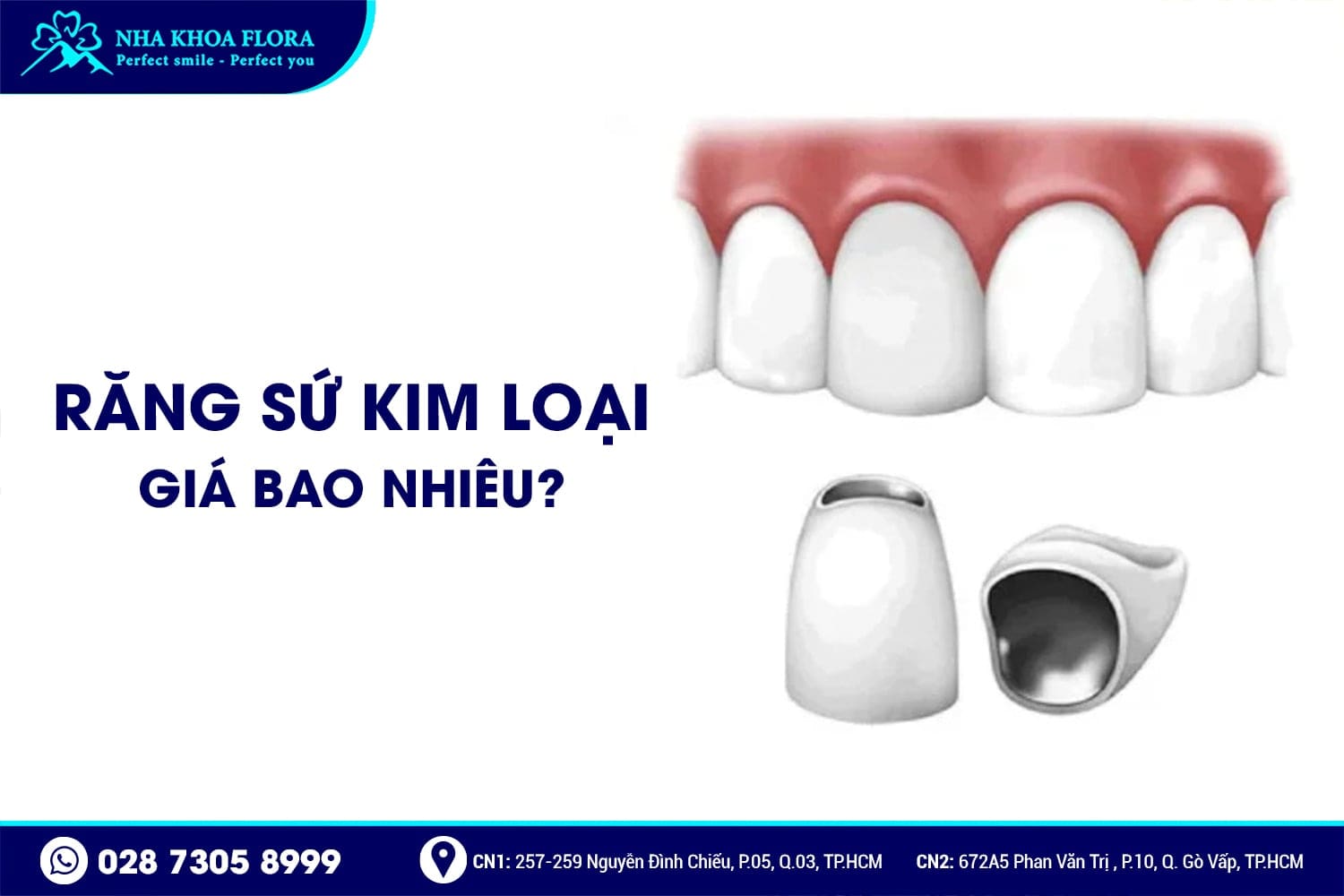 Răng Sứ Kim Loại Là Gì? Có Mấy Loại? Giá Bao Nhiêu? - ảnh 4