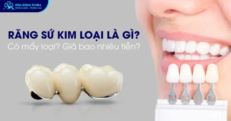 Răng Sứ Kim Loại Là Gì? Có Mấy Loại? Giá Bao Nhiêu? 2