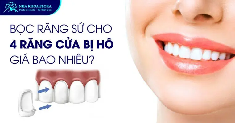 Bọc Răng Sứ Cho 4 Răng Cửa Bị Hô Giá Bao Nhiêu? 5