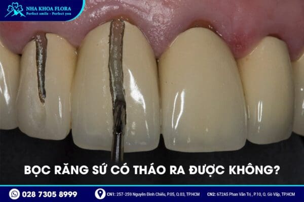 Bọc răng sứ có tháo ra được không? - ảnh 1