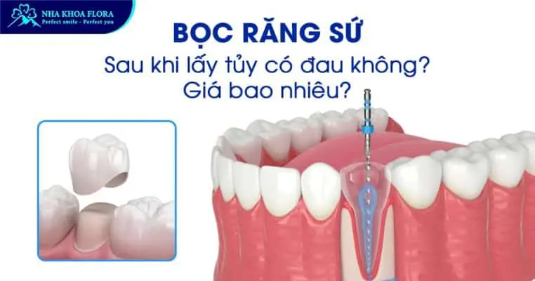 Bọc Răng Sứ Sau Khi Lấy Tủy Có Đau Không? Giá Bao Nhiêu? 4