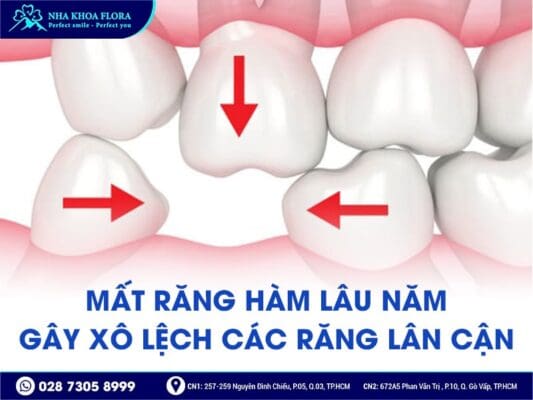 mất răng hàm lâu năm - ảnh 3