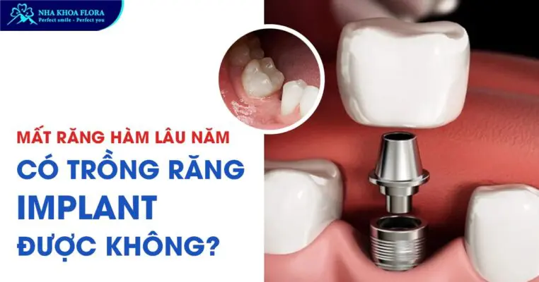 Mất răng hàm lâu năm có trồng răng Implant được không? 2