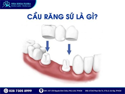 Mất răng nhai nên trồng răng Implant hay bắc cầu răng sứ? - ảnh 3