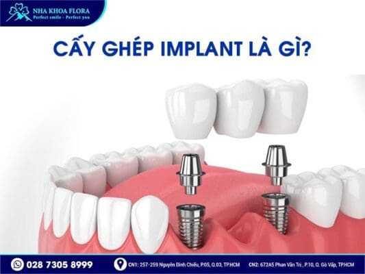 Mất răng nhai nên trồng răng Implant hay bắc cầu răng sứ? - ảnh 4