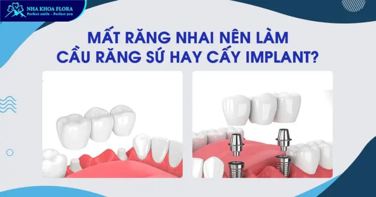 Mất răng nhai nên trồng răng Implant hay bắc cầu răng sứ? 1