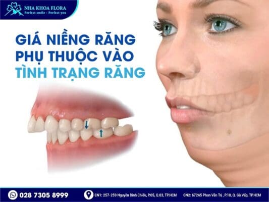 niềng răng bao nhiêu tiền - ảnh 3