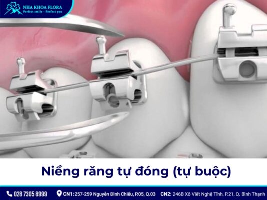 niềng răng có đau không - ảnh 4