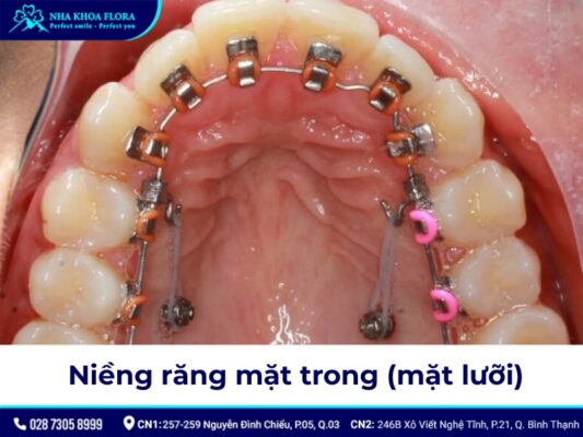 niềng răng có đau không - ảnh 5