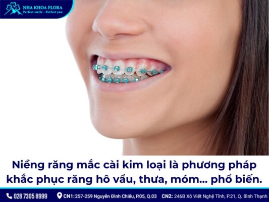 niềng răng mắc cài kim loại - ảnh 1 niềng răng mắc cài kim loại - ảnh 1