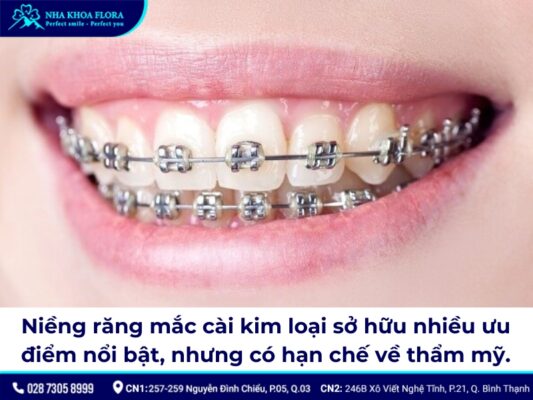 niềng răng mắc cài kim loại - ảnh 2 niềng răng mắc cài kim loại - ảnh 2