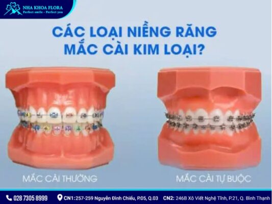 niềng răng mắc cài kim loại - ảnh 4 niềng răng mắc cài kim loại - ảnh 4