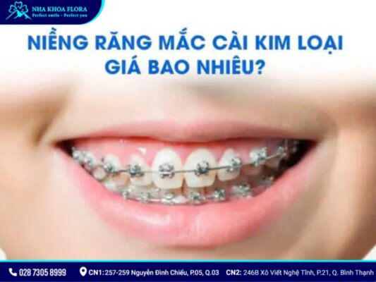 niềng răng mắc cài kim loại - ảnh 5 niềng răng mắc cài kim loại - ảnh 5