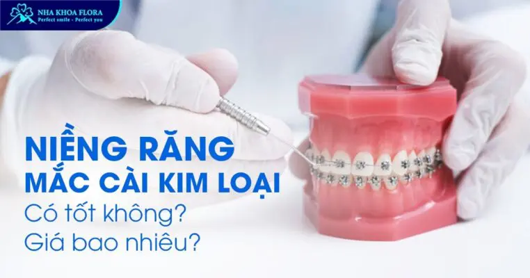 niềng răng mắc cài kim loại