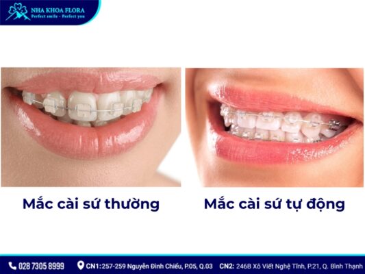 niềng răng mắc cài sứ - ảnh 3 niềng răng mắc cài sứ - ảnh 3