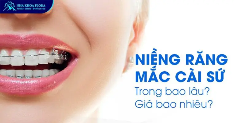 niềng răng mắc cài sứ