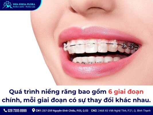 niềng răng mất bao lâu - ảnh 3