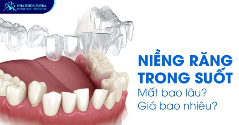 Niềng răng trong suốt mất bao lâu? Giá bao nhiêu? 1