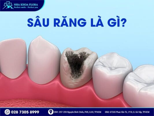 Quy trình bọc răng sứ cho răng sâu - ảnh 1 Quy trình bọc răng sứ cho răng sâu - ảnh 1