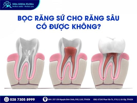 Quy trình bọc răng sứ cho răng sâu - ảnh 2 Quy trình bọc răng sứ cho răng sâu - ảnh 2