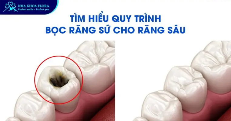 Quy Trình Bọc Răng Sứ Cho Răng Sâu Tại Nha Khoa Flora 2